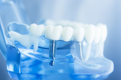 Your Place for Dental Implants in Coconut Creek